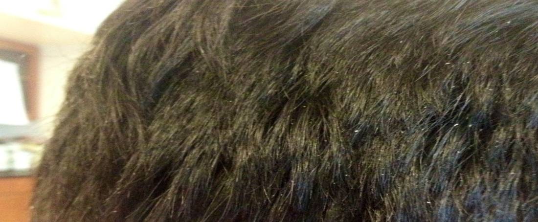 Importance of microbiome study to treat dandruff