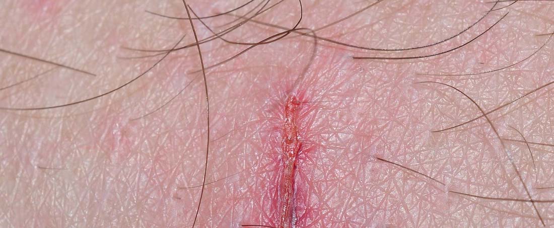 TrAPs: A mimetic wound healing approach